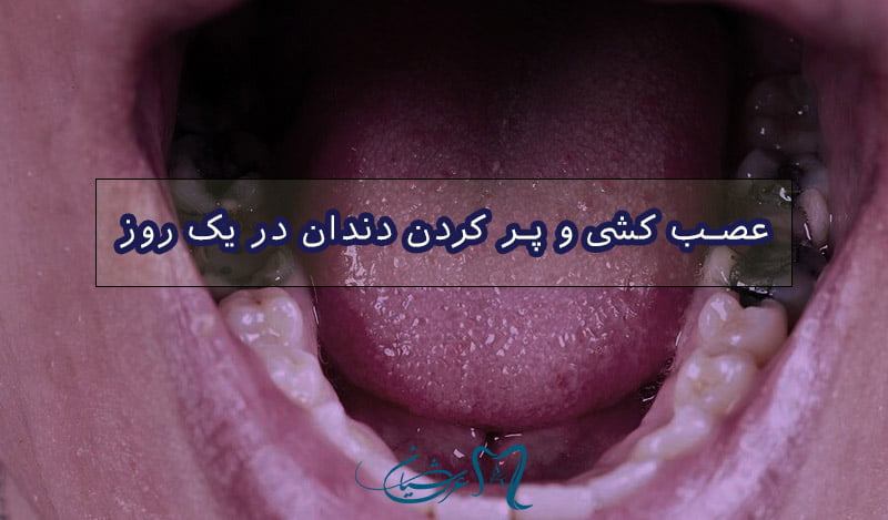 چند روز بعد از عصب کشی دندان را پر کنیم؟