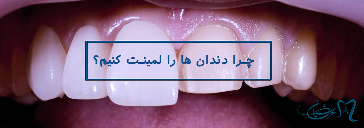 لمینت دندان در رسالت